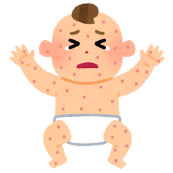 水痘 Varicelle